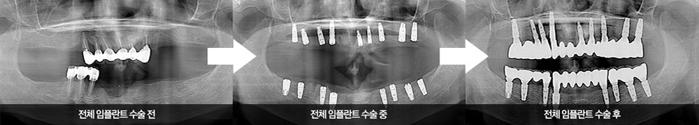 전체임플란트전후