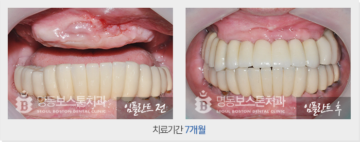 전후사진1