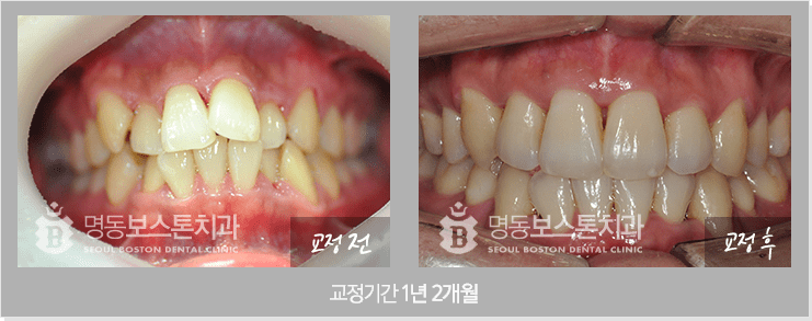 인비절라인 전후사진