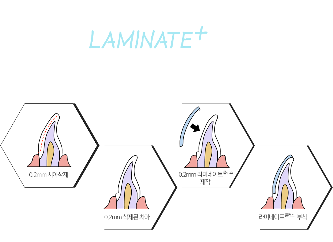 laminate+란?