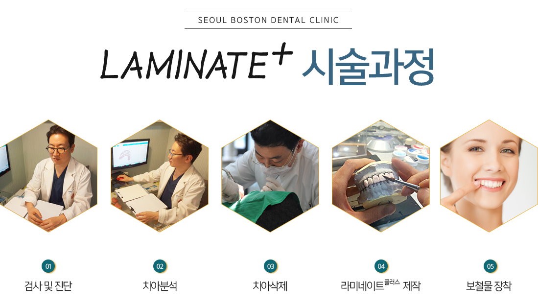 laminate+ 시술과정